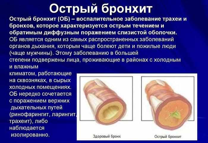 Что такое острый бронхит