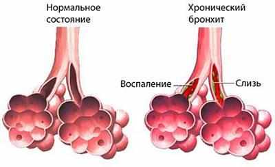 Альвеолы при бронхите