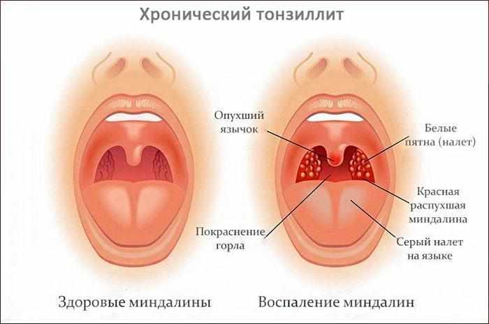симптомы хронического тонзиллита