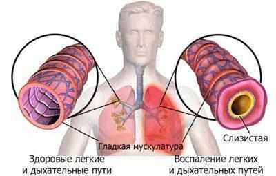 Воспаление легких