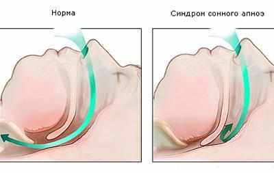 Синдром апноэ
