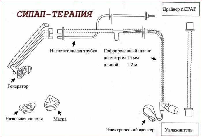 Принцип сипап терапии
