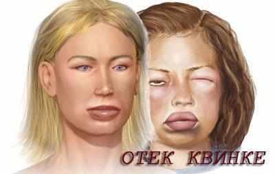 Отек квинке