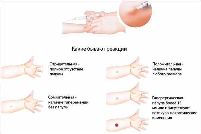 Туберкулиновая проба