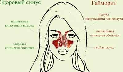 Симптомы гайморита