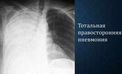 Тотальная пневмония на рентгене