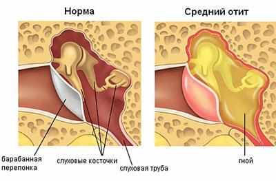 Средний отит