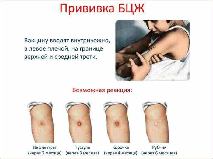 Реакция на прививку БЦЖ.