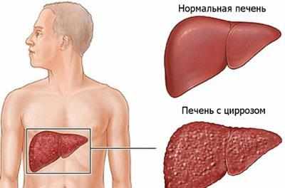 Цирроз печени