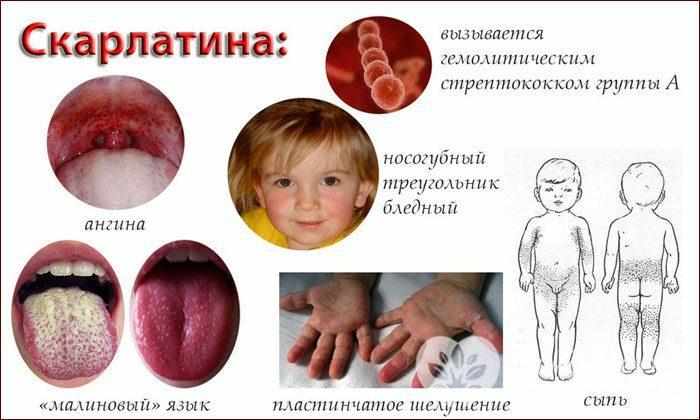 Признаки скарлатины