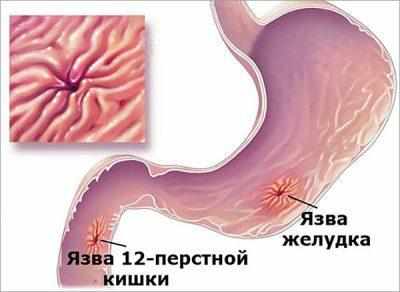 Язва двенадцатипёрстной кишки