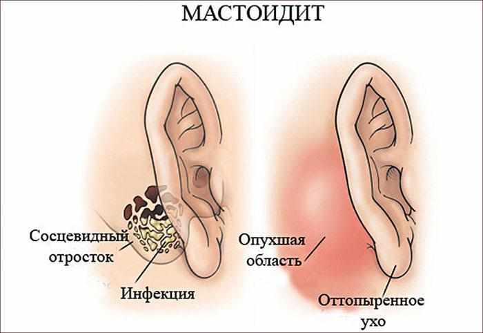 Признаки мастоидита.