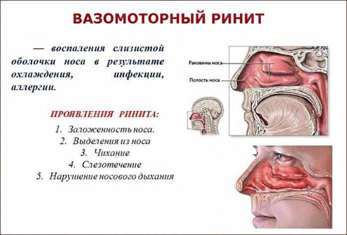 Симптомы вазомоторного ринита