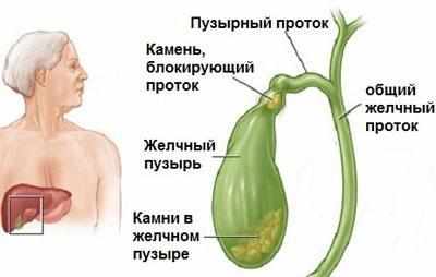 Камни в желчном пузыре