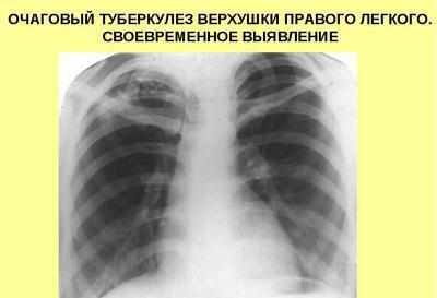 Очаговый туберкулез