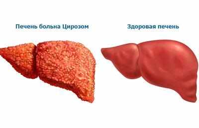Цирроз печени