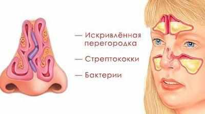 Проявление гайморита