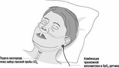 Проведение капнографии