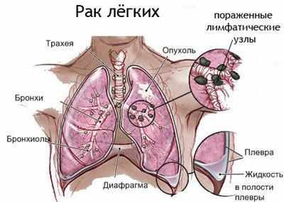 Рак легких