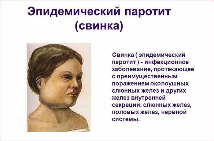 Что такое паротит