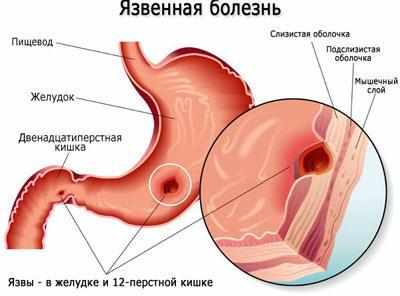 Язвенная болезнь