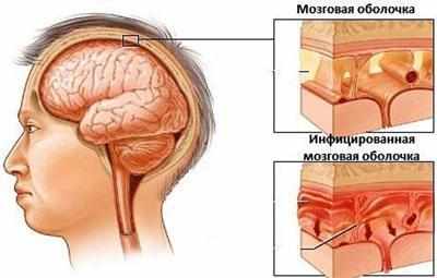 Гнойные менингит