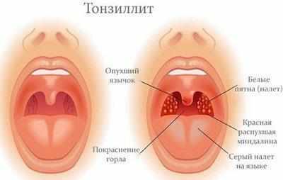 Признаки тонзиллита