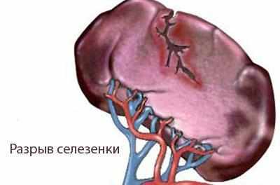 Разрыв селезенки