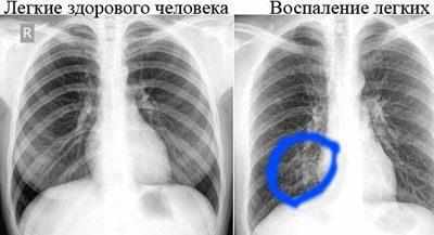 Воспаление легких на снимке