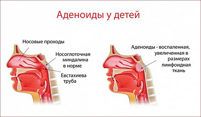 аденоиды у детей
