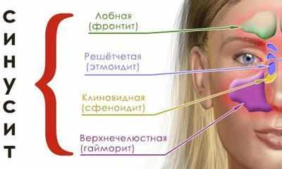 Виды синусита