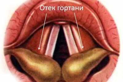 Отек гортани