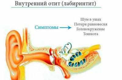 Проявление лабириндита