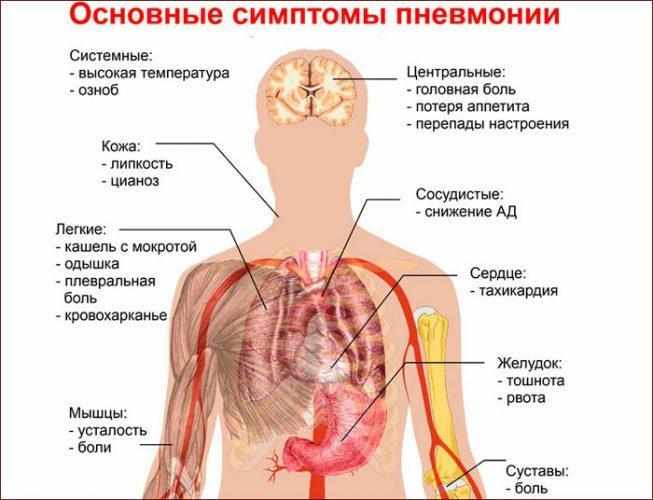 Основные симптомы пневмонии
