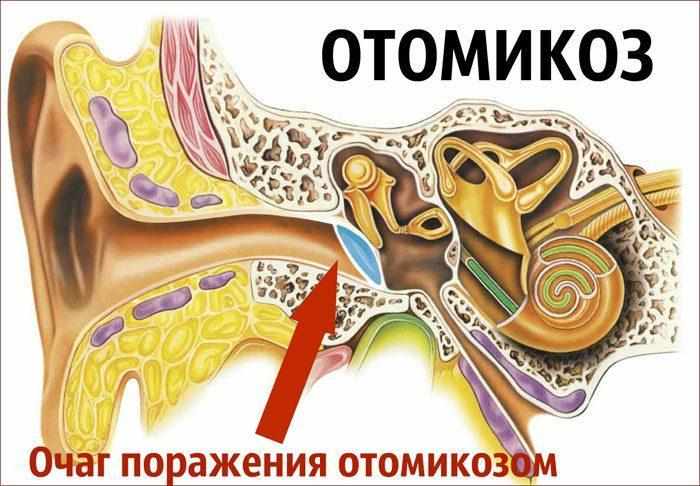 Очаг отомикоза