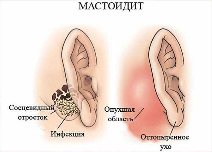 симптомы мастоидита