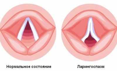 Ларингоспазм у ребенка