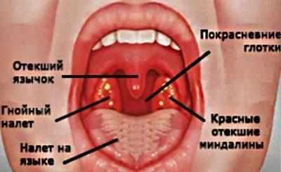 Грибковый тонзиллит