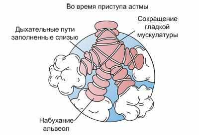 Бронхи во время приступа