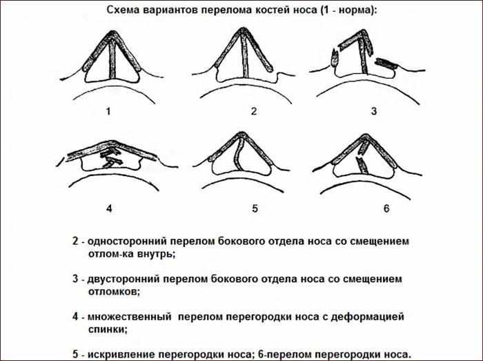 Перелом костей носа карта вызова локальный статус