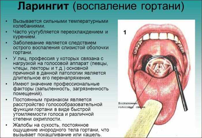 симптоматика ларингита