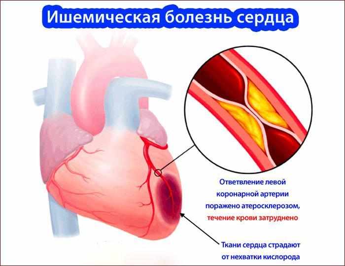 Ишемическая болезнь сердца симптомы