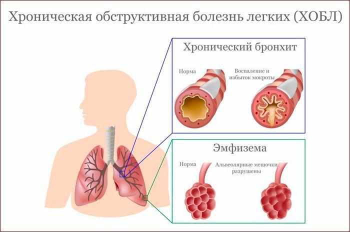 Что такое ХОБЛ