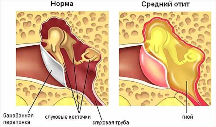 симптомы среднего отита