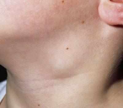 Увеличение лимфатических узлов на шее