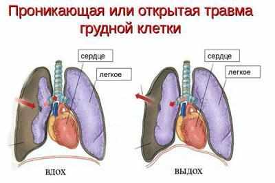 Травма грудной клетки и легкого