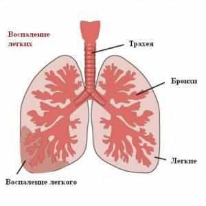 Воспаление лёгких