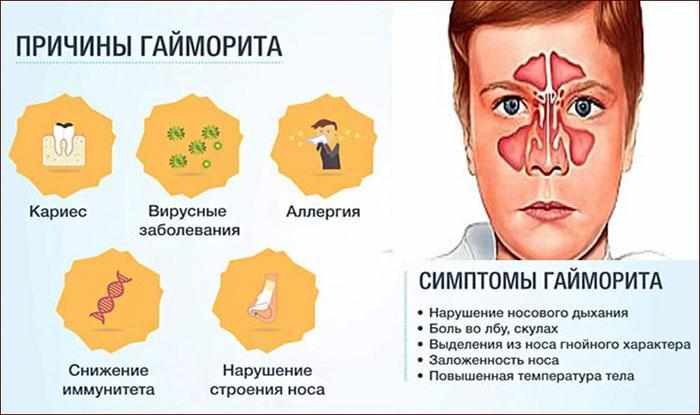 Причины и симптомы гайморита