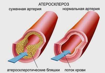 Сосуды при атеросклерозе