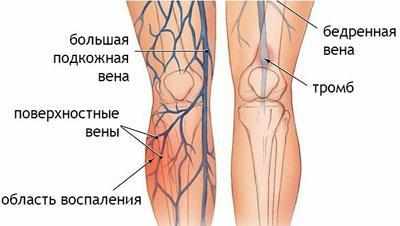 Проявление тромбофлебита